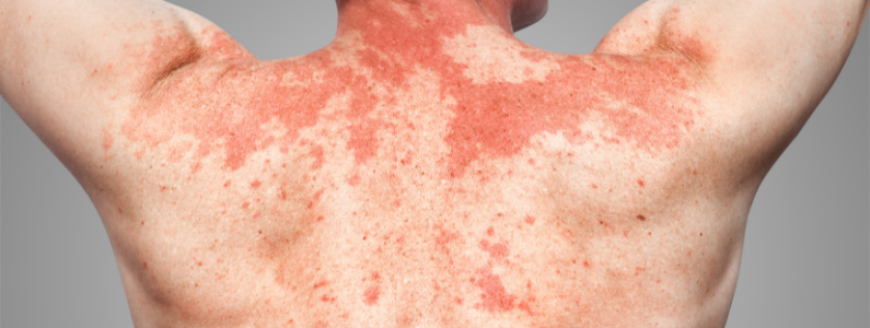 skin Allergy