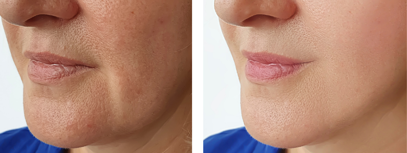 laser upper lips treatment