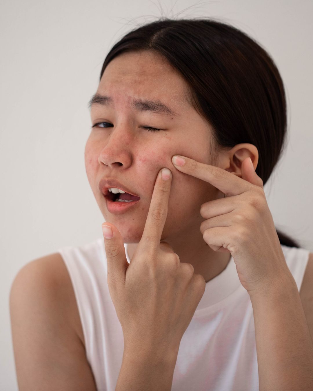 acne treatment near me in zirakpur