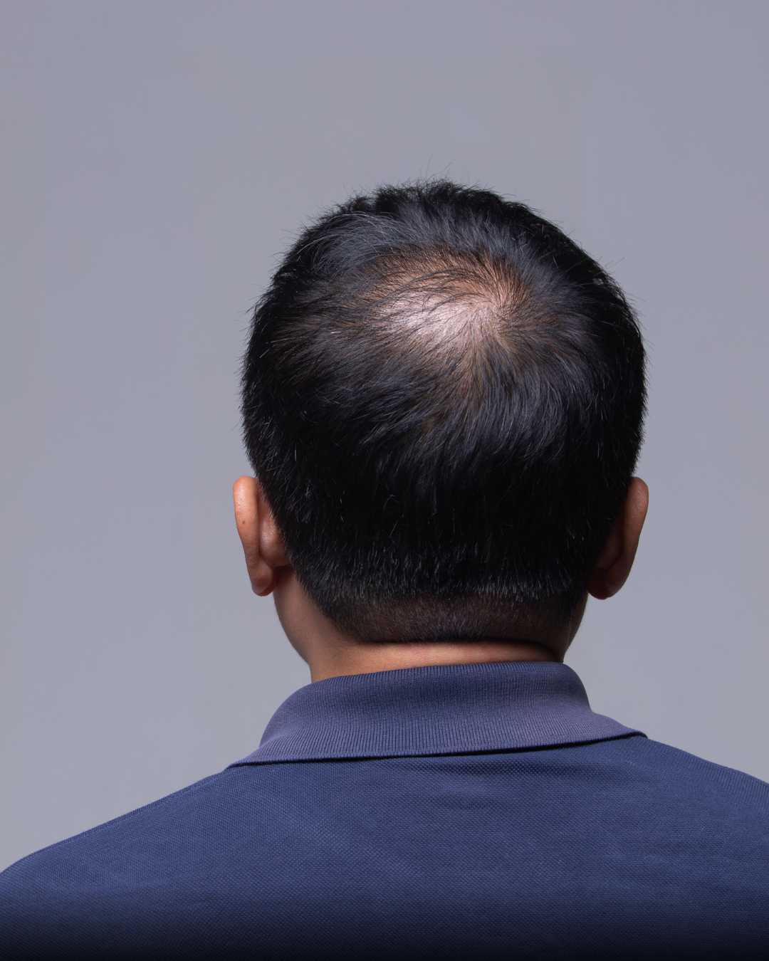 exosome treatment in zirakpur for hair fall