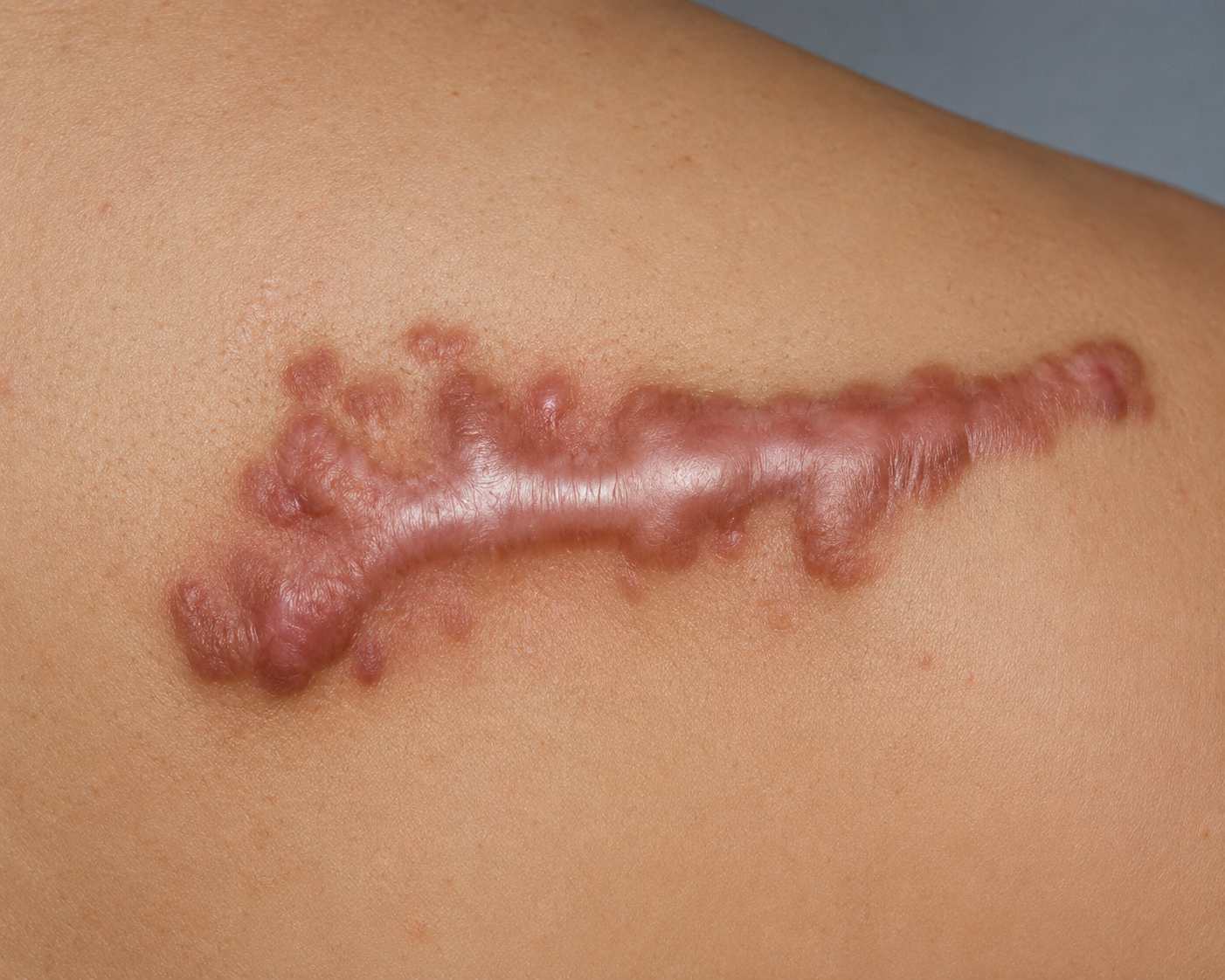 Keloid Scar Treatment in Zirakpur